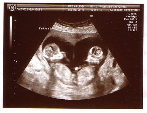 dating ultrasound twins